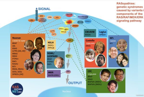 RASopathies are genetic conditions caused by variants in the RAS/RAF/MEK/ERK signaling pathway